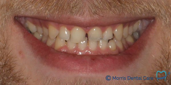 Before treatment the patient had worn teeth with some gapping